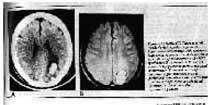 Hemoragie intracerebrală în urma terapiei electroconvulsive (ECT)